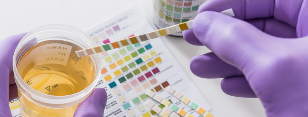 Urine dipstick test in progress-Fast & Easy Mobile Labs